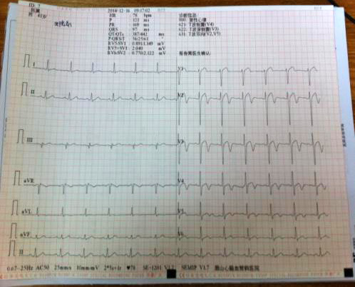 4急性心肌梗死的治疗2.jpg