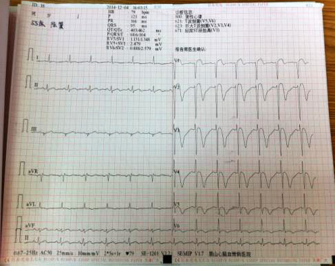 入院時患者心電圖見st段呈弓背向上抬高,t波深倒置,屬於急性心肌梗死.